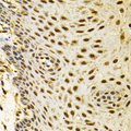 POLR2C Antibody - Immunohistochemistry of paraffin-embedded human esophageal cancer tissue.