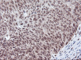 POLR2E Antibody - IHC of paraffin-embedded Carcinoma of Human bladder tissue using anti-POLR2E mouse monoclonal antibody. (Heat-induced epitope retrieval by 10mM citric buffer, pH6.0, 100C for 10min).