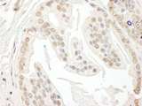 POLR3D Antibody - Detection of Human POLR3D by Immunohistochemistry. Sample: FFPE section of human prostate carcinoma. Antibody: Affinity purified rabbit anti-POLR3D used at a dilution of 1:1000 (0.2 ug/ml). Detection: DAB.
