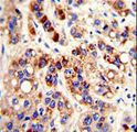 PON3 Antibody - Formalin-fixed and paraffin-embedded human hepatocarcinoma with PON3 Antibody , which was peroxidase-conjugated to the secondary antibody, followed by DAB staining. This data demonstrates the use of this antibody for immunohistochemistry; clinical relevance has not been evaluated.