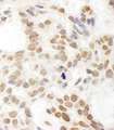 POP1 Antibody - Detection of Human POP1 by Immunohistochemistry. Sample: FFPE section of human skin carcinoma. Antibody: Affinity purified rabbit anti-POP1 used at a dilution of 1:200 (1 ug/ml). Detection: DAB.