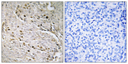 POTEA / POTE8 Antibody - Immunohistochemistry analysis of paraffin-embedded human prostate carcinoma, using POTE8 Antibody. The picture on the right is blocked with the synthesized peptide.