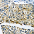 POTEG Antibody - Immunohistochemical analysis of POTEG staining in human prostate cancer formalin fixed paraffin embedded tissue section. The section was pre-treated using heat mediated antigen retrieval with sodium citrate buffer (pH 6.0). The section was then incubated with the antibody at room temperature and detected using an HRP conjugated compact polymer system. DAB was used as the chromogen. The section was then counterstained with haematoxylin and mounted with DPX.
