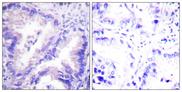 PP2Ac / PPP2CA Antibody - Peptide - + Immunohistochemistry analysis of paraffin-embedded human lung carcinoma tissue using PP2A-a (Ab-307) antibody.