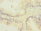 PPIL2 / CYP60 Antibody - Immunohistochemistry of paraffin-embedded human prostate cancer at dilution 1:100
