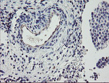 PPIL6 Antibody - IHC of paraffin-embedded Carcinoma of Human bladder tissue using anti-PPIL6 mouse monoclonal antibody.
