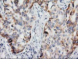 PPM1B Antibody - IHC of paraffin-embedded Carcinoma of Human lung tissue using anti-PPM1B mouse monoclonal antibody.