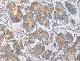 PPM1F Antibody - Immunohistochemistry of paraffin-embedded Human colon cancer using PPM1F Polyclonal Antibody at dilution of 1:40.