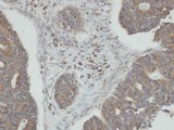 PPM1K Antibody - IHC of paraffin-embedded endo mitral OVCA using PPM1K antibody at 1:100 dilution.