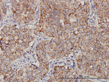 PPOX Antibody - Immunoperoxidase of monoclonal antibody to PPOX on formalin-fixed paraffin-embedded human lung, adenosquamous cell carcinoma. [antibody concentration 3 ug/ml].