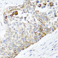 PPOX Antibody - Immunohistochemistry of paraffin-embedded human lung cancer tissue.