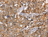 PPOX Antibody - Immunohistochemistry of paraffin-embedded Human breast cancer using PPOX Polyclonal Antibody at dilution of 1:40.