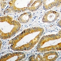 PPOX Antibody - Immunohistochemical analysis of PPOX staining in human colon cancer formalin fixed paraffin embedded tissue section. The section was pre-treated using heat mediated antigen retrieval with sodium citrate buffer (pH 6.0). The section was then incubated with the antibody at room temperature and detected using an HRP conjugated compact polymer system. DAB was used as the chromogen. The section was then counterstained with hematoxylin and mounted with DPX.