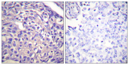 PPP1R12A / MYPT1 Antibody - Immunohistochemistry analysis of paraffin-embedded human breast carcinoma tissue, using MYPT1 Antibody. The picture on the right is blocked with the synthesized peptide.