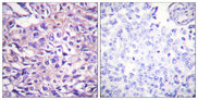 PPP1R12A / MYPT1 Antibody - Immunohistochemistry analysis of paraffin-embedded human breast carcinoma, using MYPT1 (Phospho-Thr696) Antibody. The picture on the right is blocked with the phospho peptide.