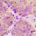 PPP1R1B / DARPP-32 Antibody - Immunohistochemical analysis of DARPP32 (pT34) staining in human breast cancer formalin fixed paraffin embedded tissue section. The section was pre-treated using heat mediated antigen retrieval with sodium citrate buffer (pH 6.0). The section was then incubated with the antibody at room temperature and detected using an HRP conjugated compact polymer system. DAB was used as the chromogen. The section was then counterstained with hematoxylin and mounted with DPX.