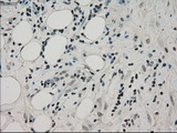PPP1R7 Antibody - Immunohistochemical staining of paraffin-embedded Carcinoma of pancreas tissue using anti-PPP1R7 mouse monoclonal antibody. (Dilution 1:50).