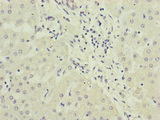 PPP2R3B Antibody - Immunohistochemistry of paraffin-embedded human liver cancer at dilution of 1:100