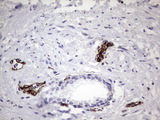 PPP2R5D Antibody - IHC of paraffin-embedded Carcinoma of Human prostate tissue using anti-PPP2R5D mouse monoclonal antibody. (Heat-induced epitope retrieval by 1 mM EDTA in 10mM Tris, pH8.5, 120°C for 3min).