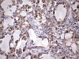 PPP2R5D Antibody - IHC of paraffin-embedded Carcinoma of Human lung tissue using anti-PPP2R5D mouse monoclonal antibody. (Heat-induced epitope retrieval by 1 mM EDTA in 10mM Tris, pH8.5, 120°C for 3min).
