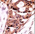 PPP3CB Antibody - Formalin-fixed and paraffin-embedded human cancer tissue reacted with the primary antibody, which was peroxidase-conjugated to the secondary antibody, followed by AEC staining. This data demonstrates the use of this antibody for immunohistochemistry; clinical relevance has not been evaluated. BC = breast carcinoma; HC = hepatocarcinoma.