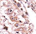 PPP3CC / CALNA3 Antibody - Formalin-fixed and paraffin-embedded human cancer tissue reacted with the primary antibody, which was peroxidase-conjugated to the secondary antibody, followed by AEC staining. This data demonstrates the use of this antibody for immunohistochemistry; clinical relevance has not been evaluated. BC = breast carcinoma; HC = hepatocarcinoma.