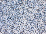 PPP5C Antibody - IHC of paraffin-embedded Carcinoma of thyroid tissue using anti-PPP5C mouse monoclonal antibody. (Dilution 1:50).