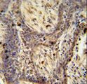PPRC1 Antibody - PPRC1 antibody immunohistochemistry of formalin-fixed and paraffin-embedded human lung carcinoma followed by peroxidase-conjugated secondary antibody and DAB staining.