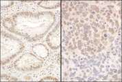 PQBP1 Antibody - Detection of Human and Mouse PQBP1 by Immunohistochemistry. Sample: FFPE section of human breast carcinoma (left) and mouse teratoma (right). Antibody: Affinity purified rabbit anti-PQBP1 used at a dilution of 1:1000 (1 ug/mg).
