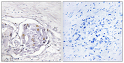 PR / Progesterone Receptor Antibody - Immunohistochemistry analysis of paraffin-embedded human liver carcinoma tissue, using Progesterone Receptor Antibody. The picture on the right is blocked with the synthesized peptide.