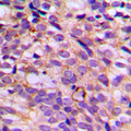 PRAGMIN / SGK223 Antibody - Immunohistochemical analysis of SGK223 (pY413) staining in human breast cancer formalin fixed paraffin embedded tissue section. The section was pre-treated using heat mediated antigen retrieval with sodium citrate buffer (pH 6.0). The section was then incubated with the antibody at room temperature and detected using an HRP conjugated compact polymer system. DAB was used as the chromogen. The section was then counterstained with hematoxylin and mounted with DPX.
