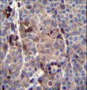 PRAMEF8 Antibody - PRAMEF8 Antibody immunohistochemistry of formalin-fixed and paraffin-embedded human melanoma tissue followed by peroxidase-conjugated secondary antibody and DAB staining.