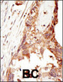 PRDM14 Antibody - Formalin-fixed and paraffin-embedded human cancer tissue reacted with the primary antibody, which was peroxidase-conjugated to the secondary antibody, followed by DAB staining. This data demonstrates the use of this antibody for immunohistochemistry; clinical relevance has not been evaluated. BC = breast carcinoma; HC = hepatocarcinoma.