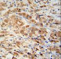 PRDX1 / Peroxiredoxin 1 Antibody - PRDX1 Antibody immunohistochemistry of formalin-fixed and paraffin-embedded human colon carcinoma followed by peroxidase-conjugated secondary antibody and DAB staining.