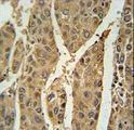 PRDX6 / Peroxiredoxin 6 Antibody - PRDX6 Antibody immunohistochemistry of formalin-fixed and paraffin-embedded human hepatocarcinoma followed by peroxidase-conjugated secondary antibody and DAB staining.