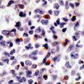 PRF1 / Perforin Antibody - Formalin-fixed, paraffin-embedded human lymphoma stained with peroxidase-conjugate and AEC chromogen. Note granular cytoplasmic staining of lymphocytes.