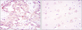 PRKAA1 / AMPK Alpha 1 Antibody - IHC of paraffin-embedded ovarian cancer (left) and brain tissues (right) using PRKAA1 mouse monoclonal antibody with DAB staining.