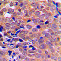 PRKAA1 + PRKAA2 Antibody - Immunohistochemical analysis of AMPK alpha 1/2 staining in human breast cancer formalin fixed paraffin embedded tissue section. The section was pre-treated using heat mediated antigen retrieval with sodium citrate buffer (pH 6.0). The section was then incubated with the antibody at room temperature and detected using an HRP conjugated compact polymer system. DAB was used as the chromogen. The section was then counterstained with hematoxylin and mounted with DPX.