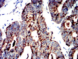 PRKAA2 / AMPK Alpha 2 Antibody - Immunohistochemical analysis of paraffin-embedded rectum cancer tissues using PRKAA2 mouse mAb with DAB staining.