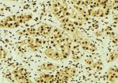 PRKACA Antibody - 1:100 staining human breast carcinoma tissue by IHC-P. The sample was formaldehyde fixed and a heat mediated antigen retrieval step in citrate buffer was performed. The sample was then blocked and incubated with the antibody for 1.5 hours at 22°C. An HRP conjugated goat anti-rabbit antibody was used as the secondary.