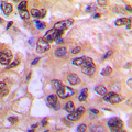 Antibody - Immunohistochemical analysis of PKA C alpha/beta staining in human breast cancer formalin fixed paraffin embedded tissue section. The section was pre-treated using heat mediated antigen retrieval with sodium citrate buffer (pH 6.0). The section was then incubated with the antibody at room temperature and detected using an HRP conjugated compact polymer system. DAB was used as the chromogen. The section was then counterstained with hematoxylin and mounted with DPX.