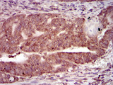 PRKACG Antibody - IHC of paraffin-embedded rectum cancer tissues using PRKACG mouse monoclonal antibody with DAB staining.