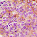 PRKACG Antibody - Immunohistochemical analysis of PKA C gamma staining in human breast cancer formalin fixed paraffin embedded tissue section. The section was pre-treated using heat mediated antigen retrieval with sodium citrate buffer (pH 6.0). The section was then incubated with the antibody at room temperature and detected using an HRP-conjugated compact polymer system. DAB was used as the chromogen. The section was then counterstained with hematoxylin and mounted with DPX.