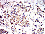 PRKAG1 / AMPK Gamma 1 Antibody - IHC of paraffin-embedded breast cancer tissues using PRKAG1 mouse monoclonal antibody with DAB staining.