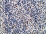 PRKAR1B Antibody - IHC of paraffin-embedded Human lymphoma tissue using anti-PRKAR1B mouse monoclonal antibody.
