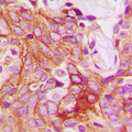 PRKCB / PKC-Beta Antibody - Immunohistochemical analysis of PKC beta (pS661) staining in human breast cancer formalin fixed paraffin embedded tissue section. The section was pre-treated using heat mediated antigen retrieval with sodium citrate buffer (pH 6.0). The section was then incubated with the antibody at room temperature and detected using an HRP conjugated compact polymer system. DAB was used as the chromogen. The section was then counterstained with hematoxylin and mounted with DPX.