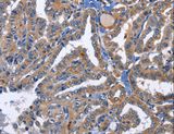 PRKCD / PKC-Delta Antibody - Immunohistochemistry of paraffin-embedded Human thyroid cancer using PRKCD Polyclonal Antibody at dilution of 1:30.