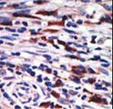 PRKCH / PKC-Eta Antibody - Formalin-fixed and paraffin-embedded human cancer tissue reacted with the primary antibody, which was peroxidase-conjugated to the secondary antibody, followed by AEC staining. This data demonstrates the use of this antibody for immunohistochemistry; clinical relevance has not been evaluated. BC = breast carcinoma; HC = hepatocarcinoma.