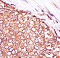 PRKCQ / PKC-Theta Antibody - Formalin-fixed and paraffin-embedded human cancer tissue reacted with the primary antibody, which was peroxidase-conjugated to the secondary antibody, followed by DAB staining. This data demonstrates the use of this antibody for immunohistochemistry; clinical relevance has not been evaluated. BC = breast carcinoma; HC = hepatocarcinoma.