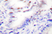 PRKCZ / PKC-Zeta Antibody - IHC of p-PKC (T410) pAb in paraffin-embedded human lung carcinoma tissue.